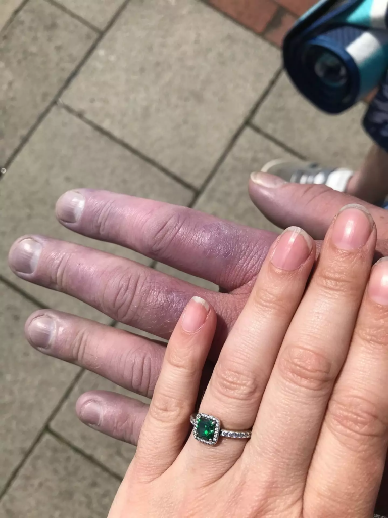 Scott has opened up about his symptoms