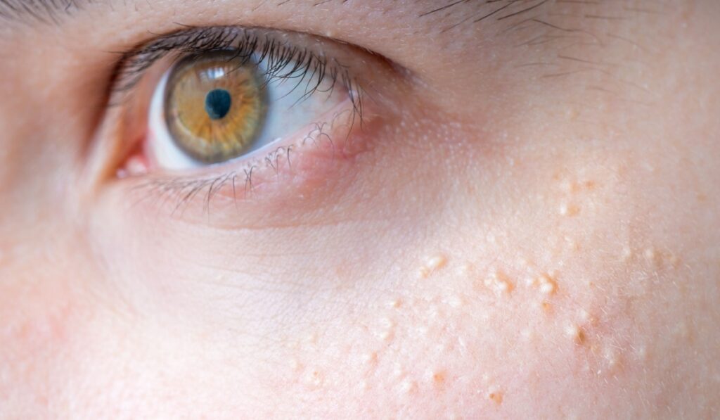 Milia (Milium) - pimples around eye on skin.