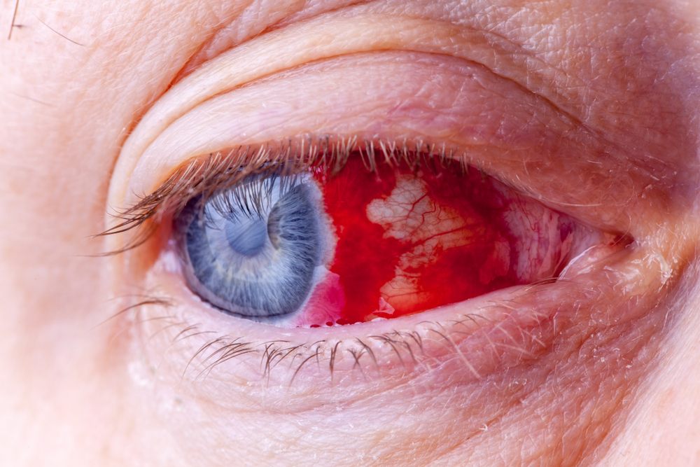 Bloodshot eye. Close-up macro image of a very red bloody eyeball. Bleeding damage in the eye
