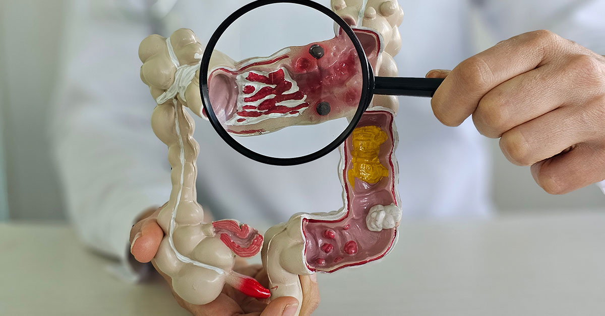 Colorectal Cancer Specialist Reveals 5 Things They’d Never Do