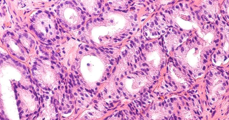 Is Cancer Reversible? New Treatment May Transform Cancer Cells into Healthy Ones - Featured image