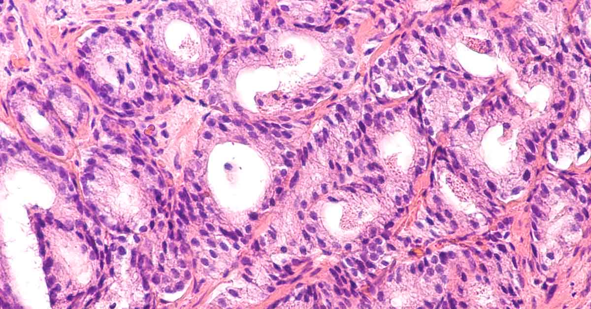 Is Cancer Reversible? New Treatment May Transform Cancer Cells into Healthy Ones