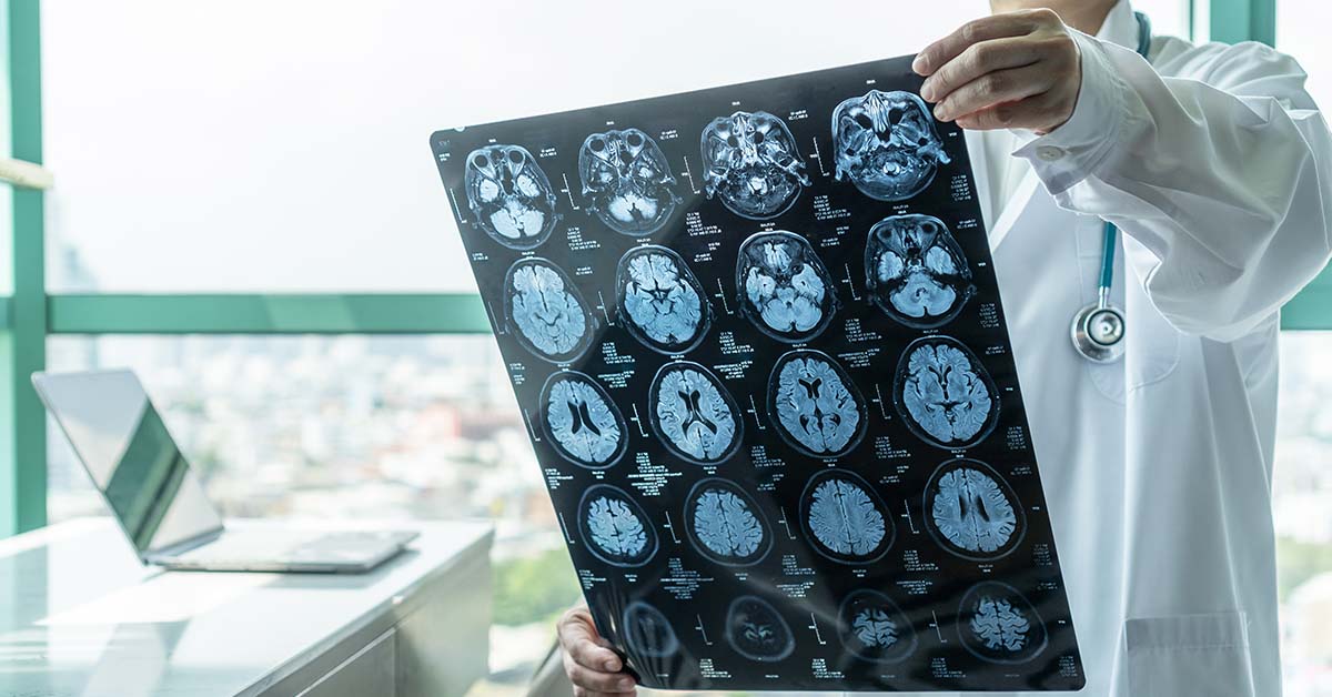 Virus Most People Encounter May Play a Role in Developing Alzheimer’s, Study Suggests