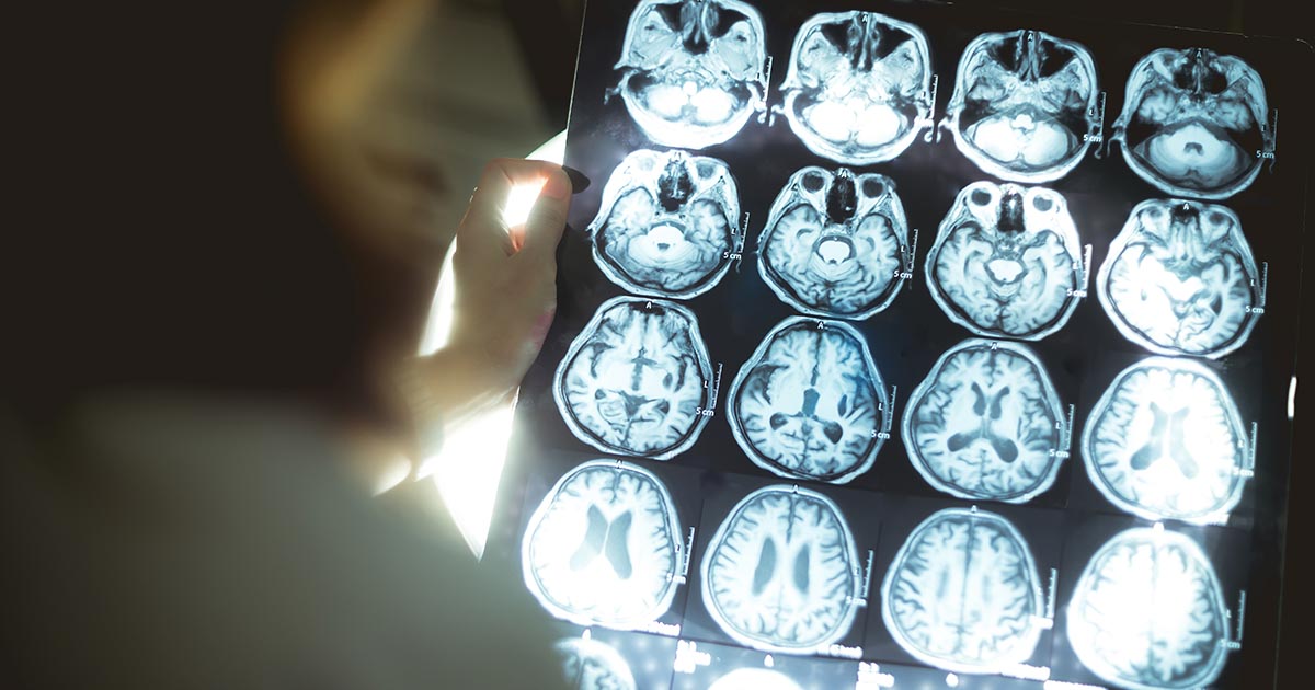 The Surprising Link Between Dreams and Dementia or Parkinson’s Disease