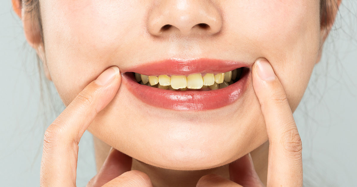 Why Your Teeth Are Yellow Even Though You Brush Them: Dentist