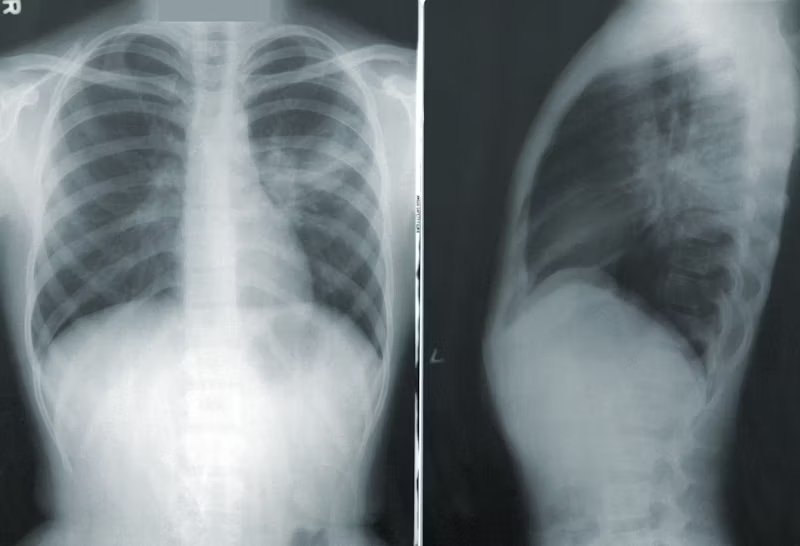 x ray of damaged lungs