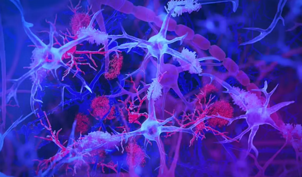 Brain’s immune cells, light blue and purple, shown interacting with amyloid plaques, red, linked to Alzheimer’s disease