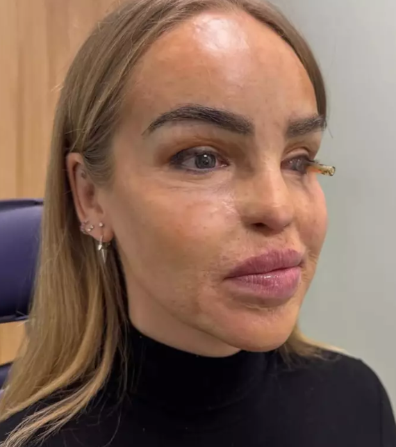 katie piper's eye procedure 