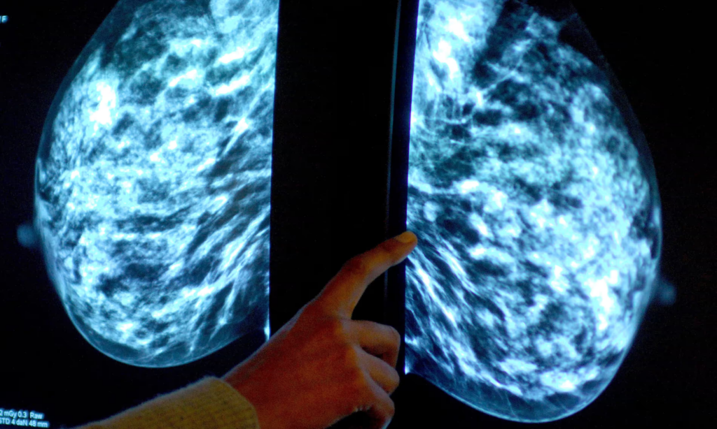 Researchers found that one additional case of cancer was spotted for every 1,000 women screened when AI was used. 