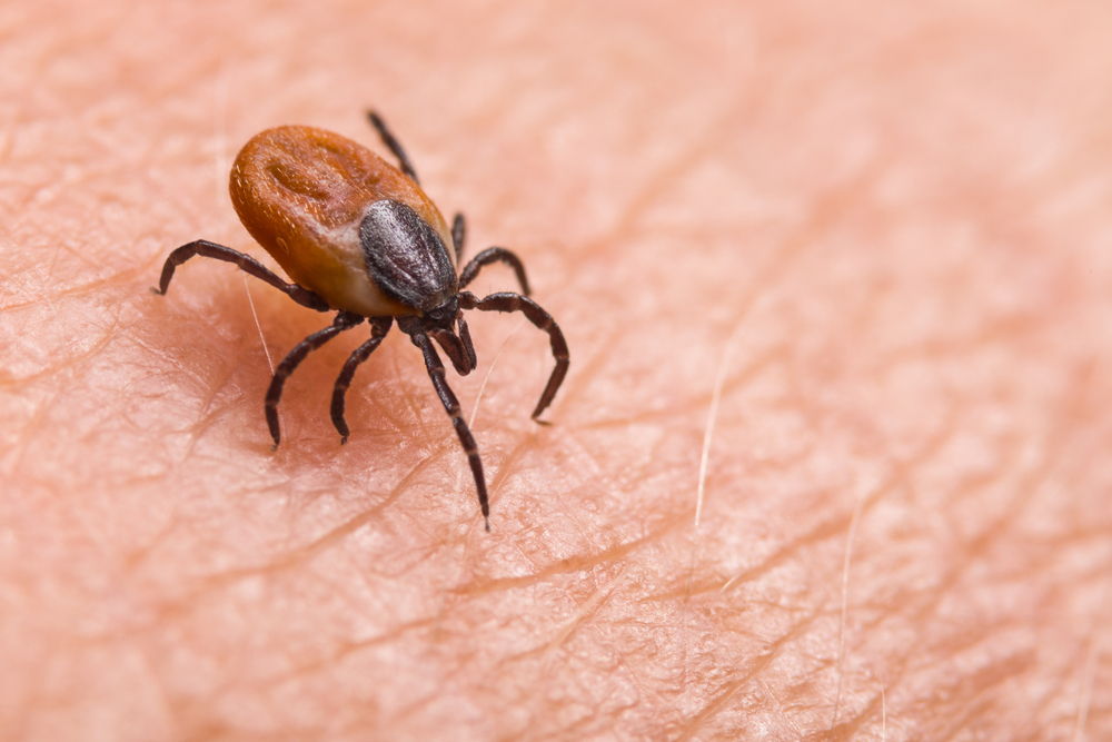 Infected female deer tick on hairy human skin. Ixodes ricinus. Parasitic mite. Acarus. Dangerous biting insect on background of epidermis detail. Disgusting carrier of infections. Tick-borne diseases.
