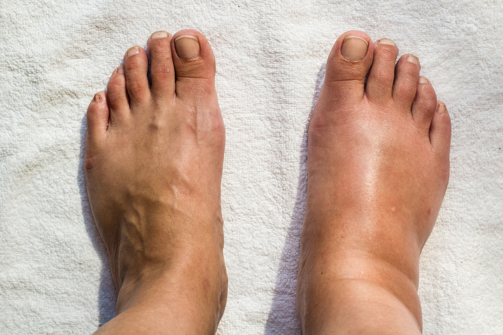 Swollen feet bite by insect