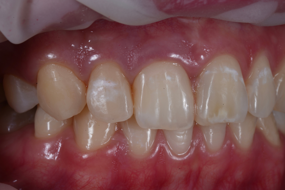 closeup dental fluorosis at upper anterior teeth
