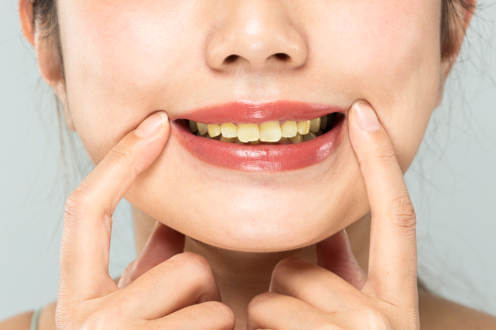 The teeth of the women are yellowed.