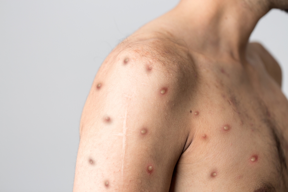 Monkeypox new disease dangerous over the world.
