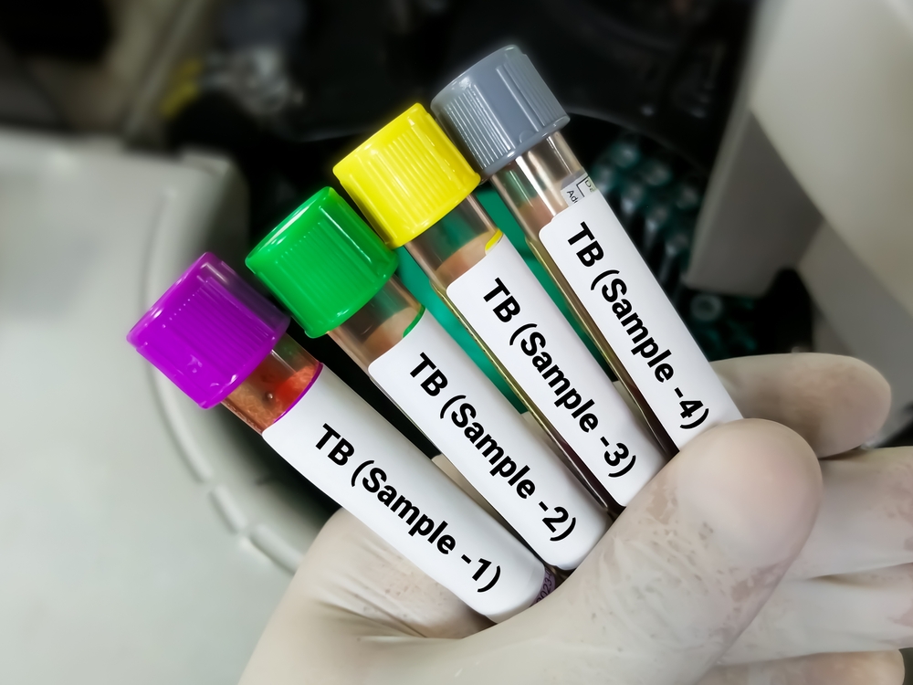 Close view of scientist hand hold blood samples for TB Gold or Quantiferon test. 4 samples for TB test. diagnosis for mycobacterium tuberculosis infection.