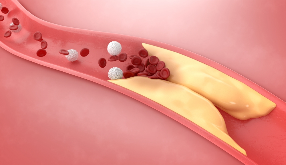Thickened Arteries and Veins, Coronary heart disease, High cholesterrol, 3D Rendering.
