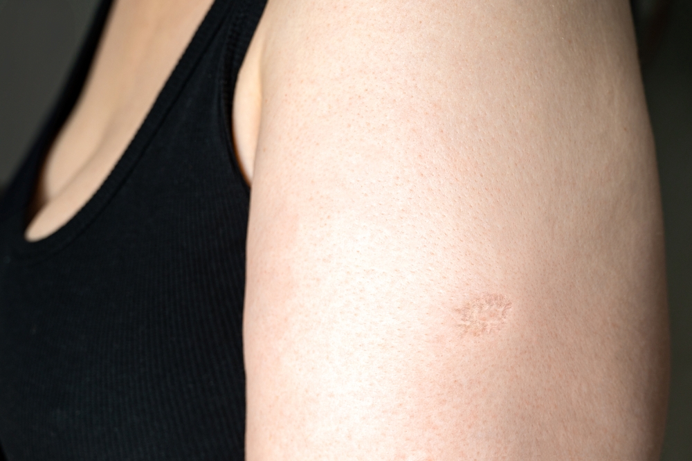 BCG or TB vaccine scar marks Monkeypox and smallpox vaccines on a woman's left arm
