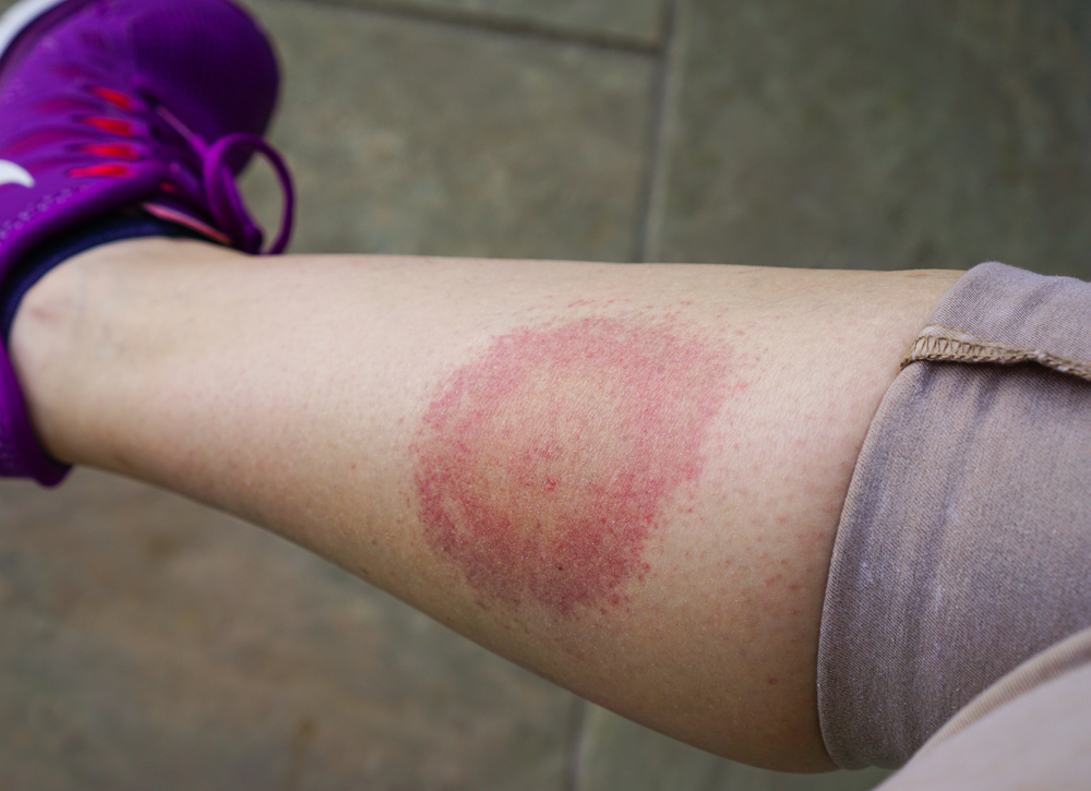 Lyme disease, Borreliosis or Borrelia, typical lyme rash, spot. A person, leg bitten by a deer tick. Selective focus.
