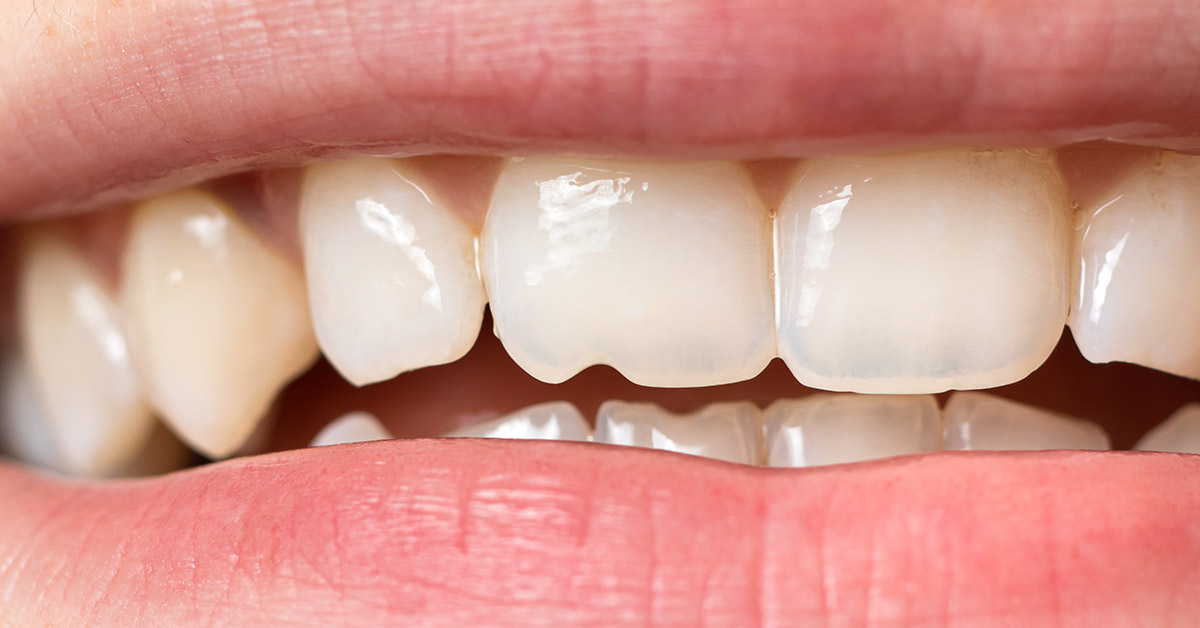 Regrowing Teeth Is on the Horizon and May Represent the Future of Dentistry