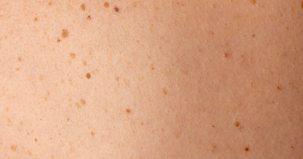 5 Subtle Skin Changes That Could Signal Cancer - Featured image