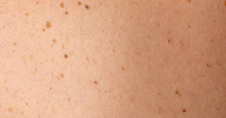 5 Subtle Skin Changes That Could Signal Cancer - Featured image
