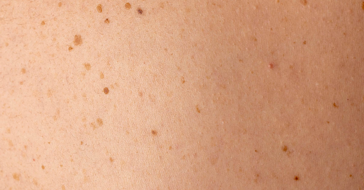 5 Subtle Skin Changes That Could Signal Cancer