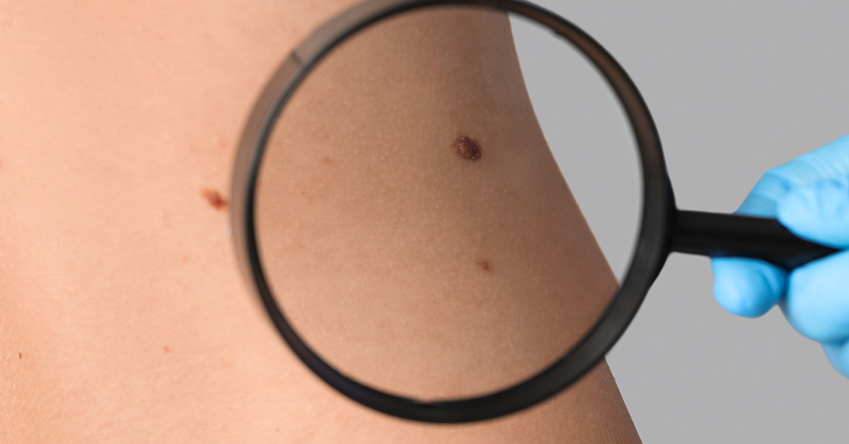 Experts Highlight Skin Mark Changes That Could Indicate Serious Cancer Risks