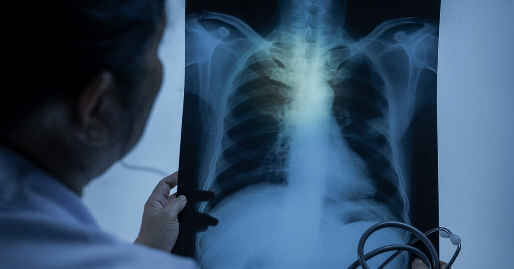 Why More Non-Smokers Are Getting Lung Cancer - Featured image