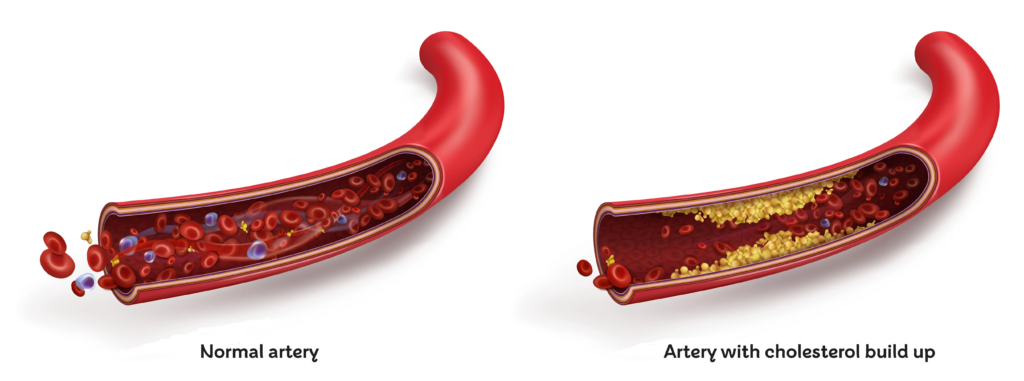 a normal artery vs one with a cholesterol builup