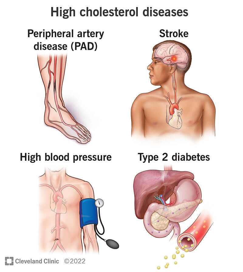 The different high-cholesterol diseases
