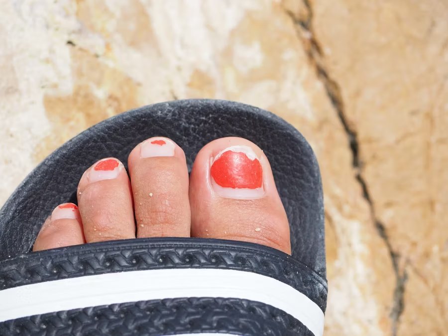 a person's foot in a sandal with nail polish coming off