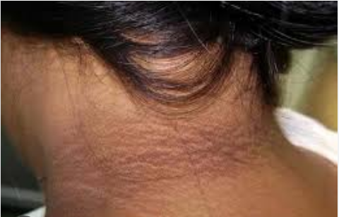 dark patch on neck of girl
