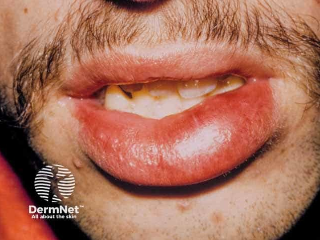 Lip angioedema