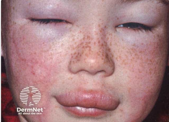 person with lip and lid angioedema