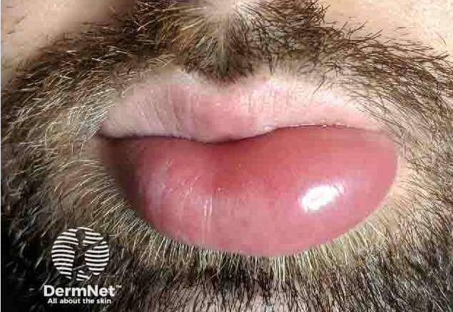man with lip angioederma