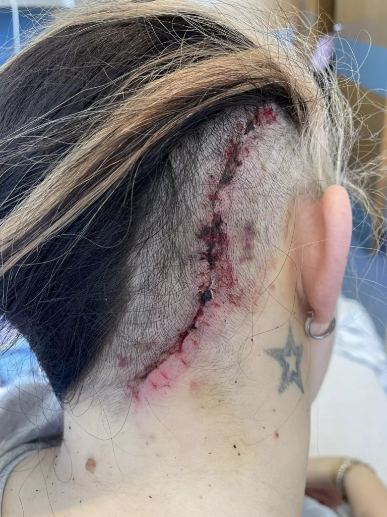 Surgery was done to remove the tumour after giving birth to her second son (Kennedy)
