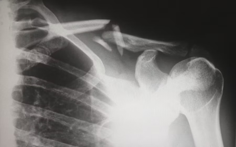 x ray of a broken collarbone