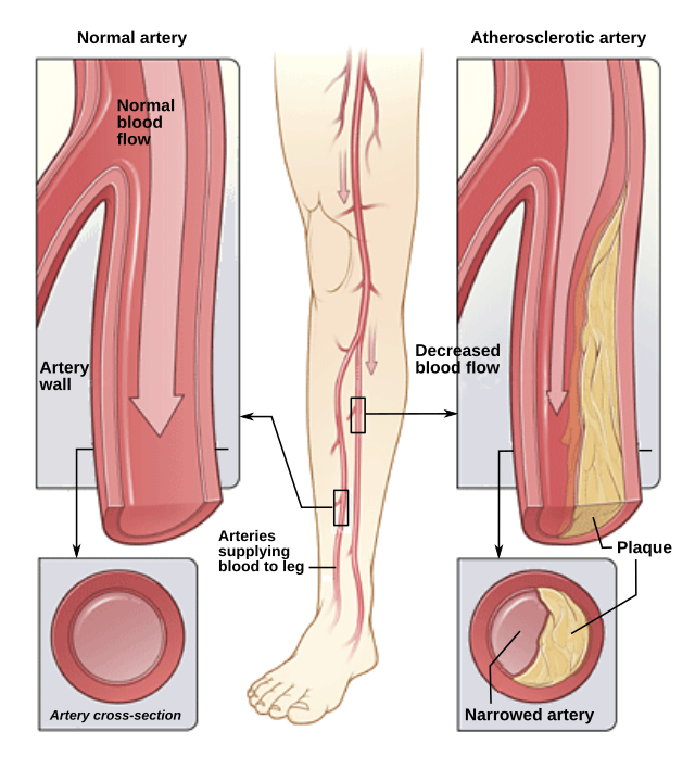 Diagram showing blood vessels in the leg, highlighting areas affected by Peripheral Artery Disease.