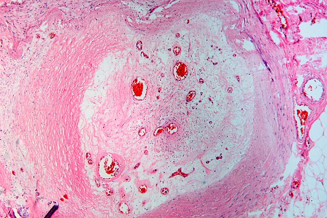 Illustration of an occluded artery in the lower leg caused by an old organized thrombus, depicting a common complication of peripheral vascular disease (PVD).