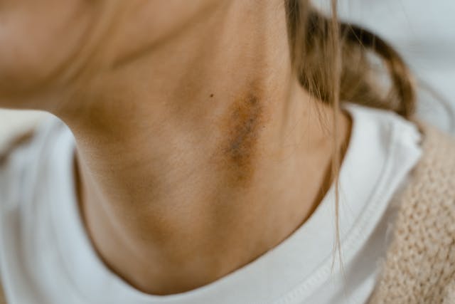 woman with dark patch on neck