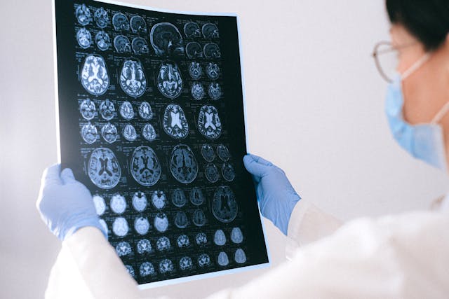 doctor holding brain scan of alzheimer's patient
