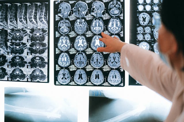 doctor pointing at brain scan
