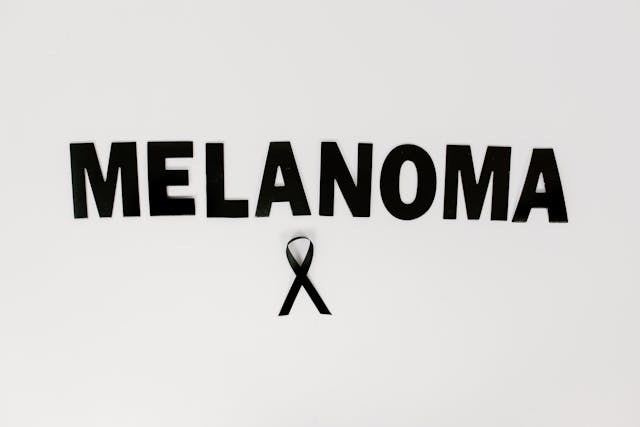 melanoma