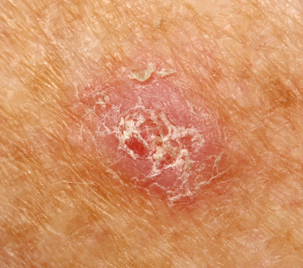 A case of an invasive squamous cell carcinoma.

