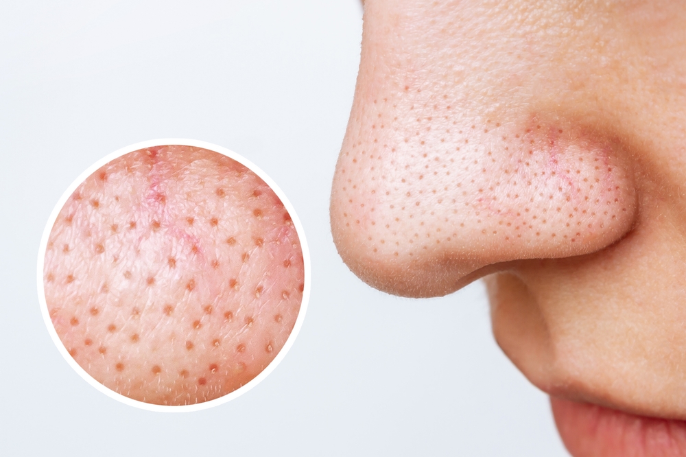 Female nose with blackheads or black dots and magnifying glass with an enlarged image of the pores on the face isolated on a white background. Acne problem, comedones. Cosmetology dermatology concept
