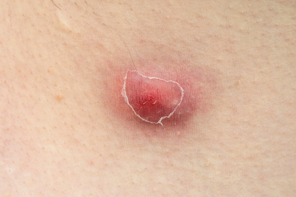 Close-up of furuncle, acne, pimple with pus under skin