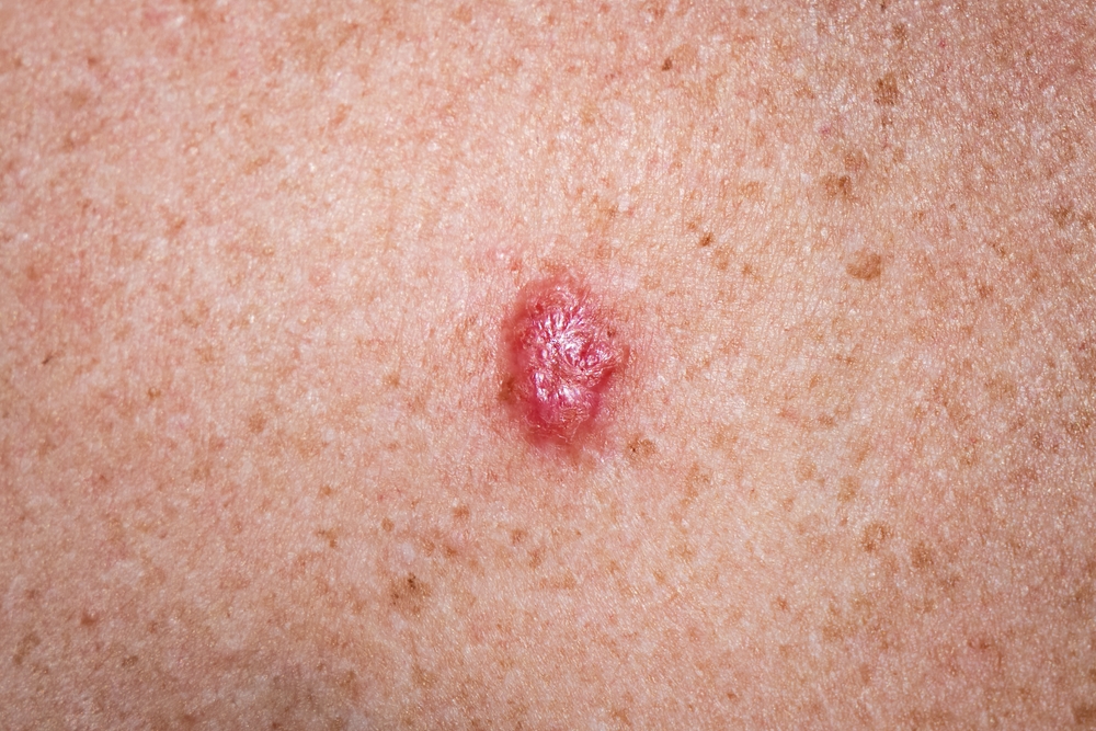 Young female 30s close up of chest prior to applying imiquimod cream medication to basal cell carcinoma.
