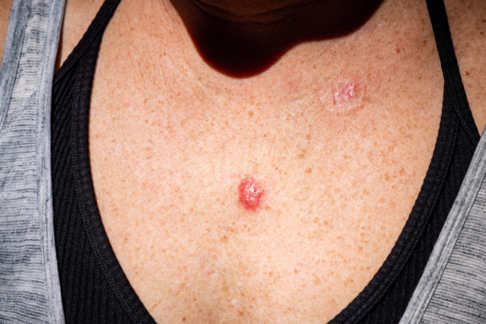 Young female 30s close up of chest prior to applying imiquimod cream medication to basal cell carcinoma.
