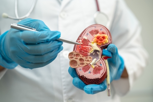 Kidney disease, Chronic kidney disease ckd, Doctor hold model to study and treat in hospital.
