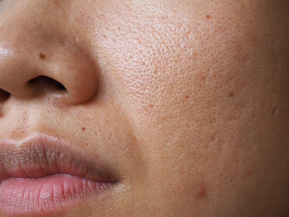 Close-up view of the middle-aged woman with big pores, acne-prone skin and smile lines, or laugh lines, noticeable between noses and around the mouth
